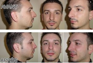 Rhinoplastie Turquie