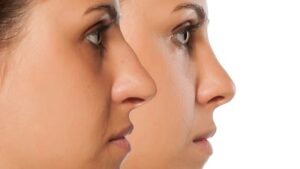Rhinoplastie fonctionnelle