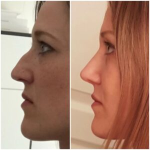 rhinoplastie voie fermee turquie