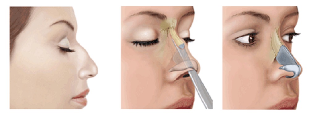 Techniques chirurgicales rhinoplastie