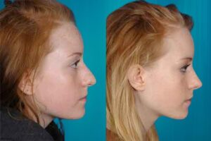 chirurgie fosses nasales