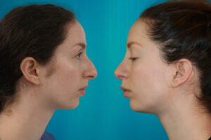rhinoplastie prix