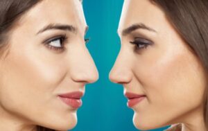 rhinoplastie physionomie